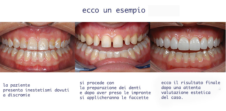 Faccette Dentali  Studio Dentistico Dott. Alberto Gentile