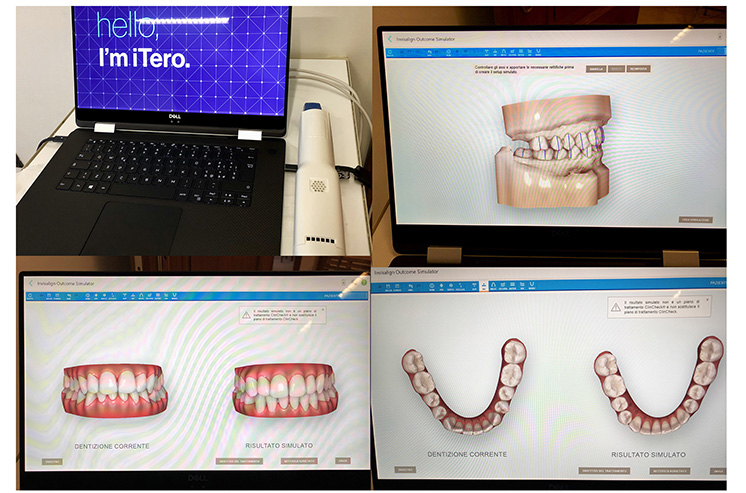 Scanner intraorale 3D